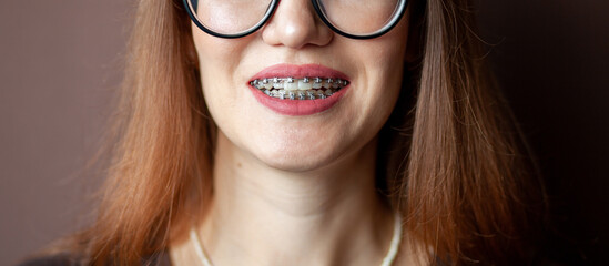 The smile of a young and beautiful girl with braces on her white teeth. Straightening of crooked...