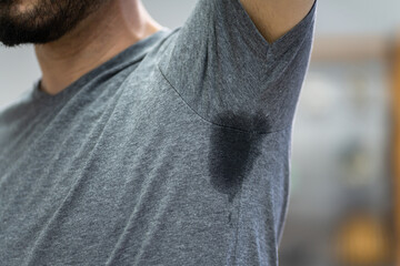 Man With Hyperhidrosis Sweating Very Badly