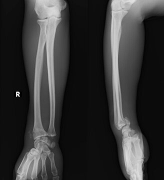 x ray image of distal radius fracture,smith fracture