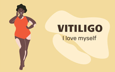 Web template with black woman with vitiligo. The concept of different beauty, body positive, self-acceptance. Banner with title Vitiligo. I love myself.