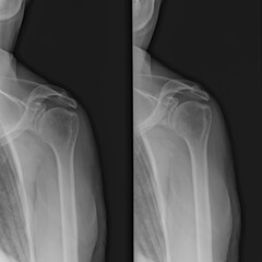 Diagnostic shoulder and arm X-ray film of a patient