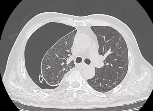 Chest ct scan lung window video shows right pneumothorax