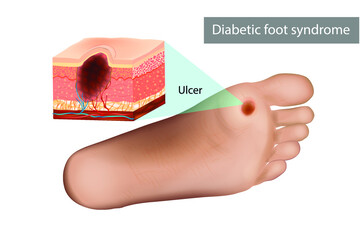 Diabetic foot syndrome ulcer. Destruction of deep tissues of the foot. Medical illustration