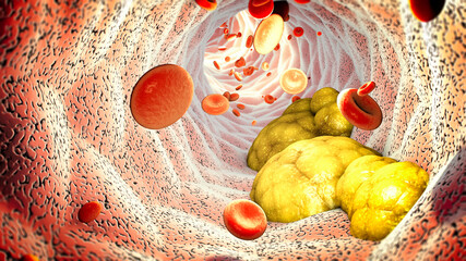 Cholesterol formation, fat, artery, vein, heart. Red blood cells, blood flow. Narrowing of a vein for fat formation. 3d rendering
