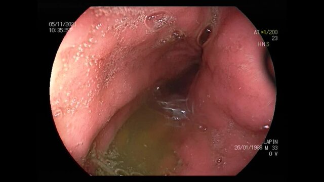 Ukraine Dnepr 07.11.2021 - intestinal gastroscopy in a man with acute intestinal inflammation, gastroscopy