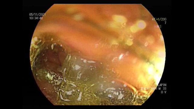 Ukraine Dnepr 07.11.2021 - intestinal gastroscopy in a man with acute intestinal inflammation, gastroscopy