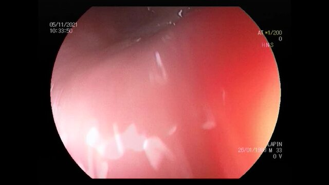 Ukraine Dnepr 07.11.2021 - intestinal gastroscopy in a man with acute intestinal inflammation, gastroscopy