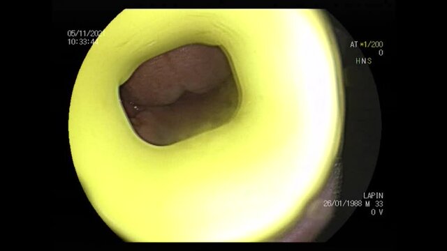 Ukraine Dnepr 07.11.2021 - intestinal gastroscopy in a man with acute intestinal inflammation, gastroscopy