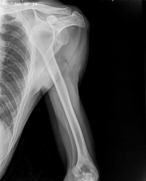 x-ray image of anterior shoulder dislocation
