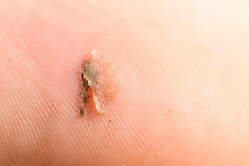 Close up of painful wound. Macro wound on the human skin. Sand particles are visible in the wound