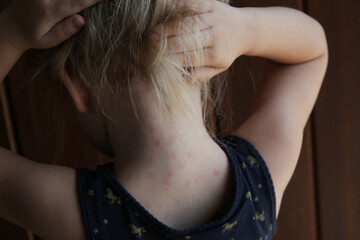 Summer rash. Common toddler skin rashes or allergy reaction with red spots