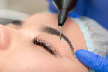 Cosmetic procedure for lifting the skin of the eyelids of Asian eyes. Non-surgical blepharoplasty with plasma IQ apparatus. Facial rejuvenation cosmetology. Beautician makes a cosmetic procedure. - obrazy, fototapety, plakaty