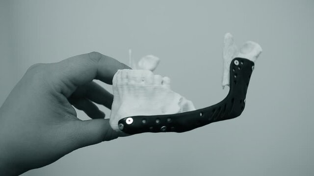 Person holding in hand facial mandibular endoprosthese printed metal 3D printer
