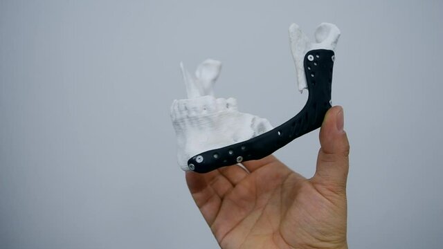 Person holding in hand facial mandibular endoprosthese printed metal 3D printer