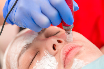 Cosmetology mesotherapy for facial rejuvenation. Mikronidling cosmetic procedure. The beautician...