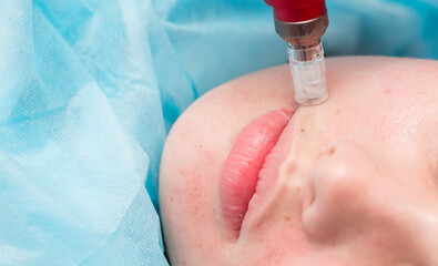 Cosmetology mesotherapy for facial rejuvenation. Mikronidling cosmetic procedure. The beautician...
