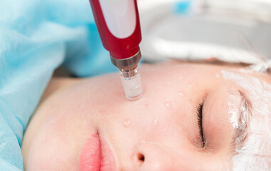 Fototapeta premium Cosmetology mesotherapy for facial rejuvenation. Mikronidling cosmetic procedure. The beautician injects hiluronic acid in the face of the girl's patient with the help of a dermopen wrinkle remover.