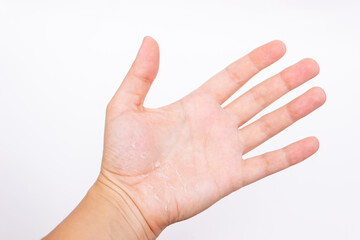 Close-up of a female hand with peeling skin on the palm isolated on a white background. Allergies,...