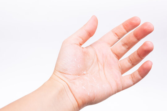 Close-up of a woman's hand with peeling skin on the palm isolated on a white background. Allergies, eczema, psoriasis, vitamin deficiency, erythema