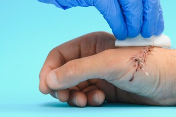 Suture wound on hand,Pain of accident concept