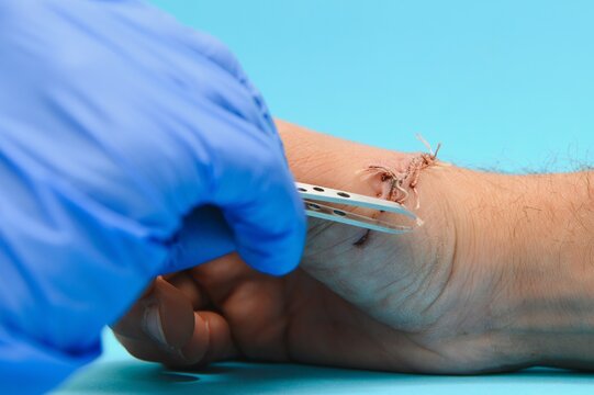 Doctor examining nerve conduction on palm of hand after carpal tunnel syndrome