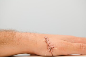 Close-up of a hand wound with stitches