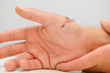 Surgery wound fix with staple on arm,isolated on white background.