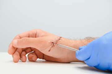 wound hand, suturing the wound. The type of cut after surgery.