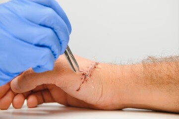 Doctor examining nerve conduction on palm of hand after carpal tunnel syndrome