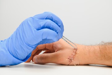 Close-up of a hand wound with stitches