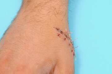 Suture wound on hand,Pain of accident concept