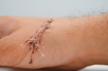 Suture wound on hand from dermatology procedure