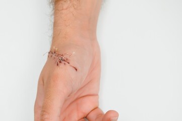 Close-up of a hand wound with stitches