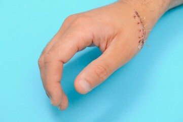 Close-up of a hand wound with stitches
