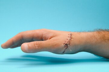 Suture wound on hand,Pain of accident concept