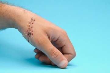 Close-up of a hand wound with stitches