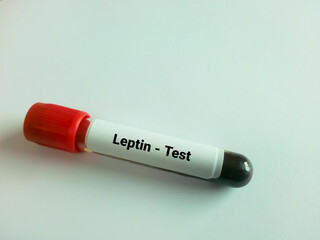 Blood sample for Leptin test. This test measures the amount of leptin in the blood to detect a deficiency that may be contributing to obesity.