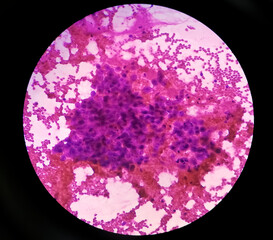 Microscopic view of CT guided FNAC showing mucoepidermoid carcinoma. 40x