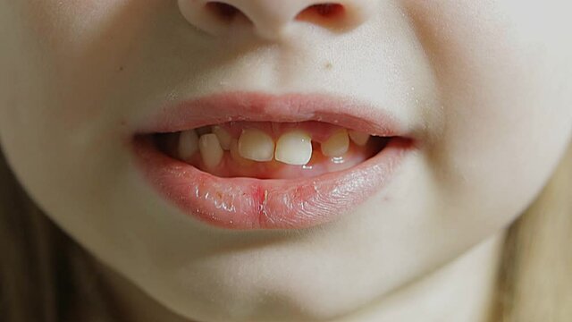malocclusion of large front teeth in young children