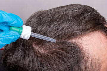 A doctor in blue medical gloves drips with a pipette strengthening drops on the hair roots for the...