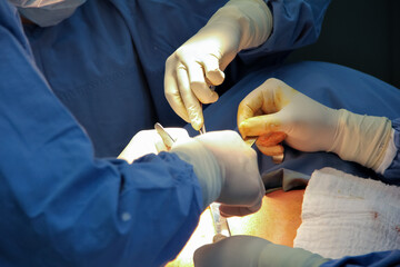 Close-up of the hands of surgeons operating a patient.