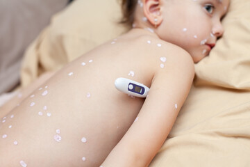 Chickenpox. Fever. A girl suffering from chickenpox lies on a bed with a thermometer. rash