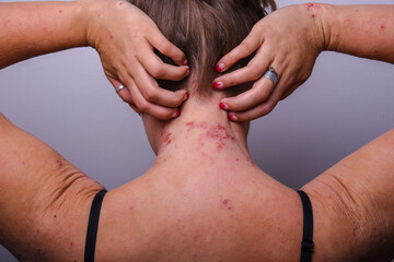 severe exacerbation of atopic dermatitis on the girl's neck. dermatology. skin problems