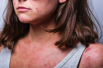 a young girl with atopic dermatitis in the acute stage. redness and scratching up to blood on the...