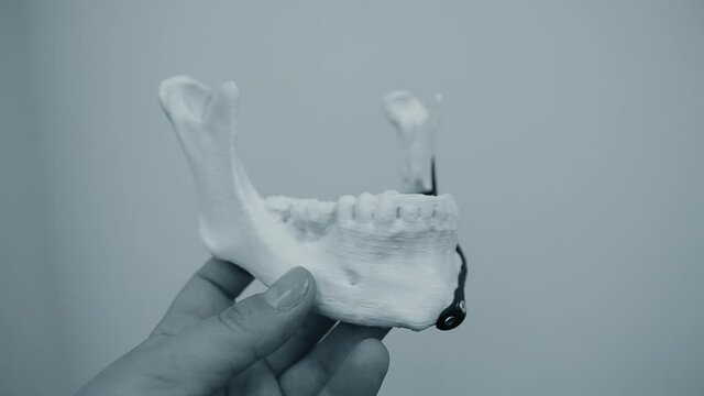 Person holding in hand facial mandibular endoprosthese printed metal 3D printer