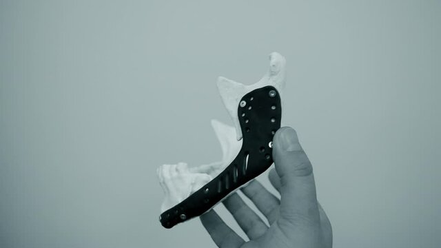 Person holding in hand facial mandibular endoprosthese printed metal 3D printer