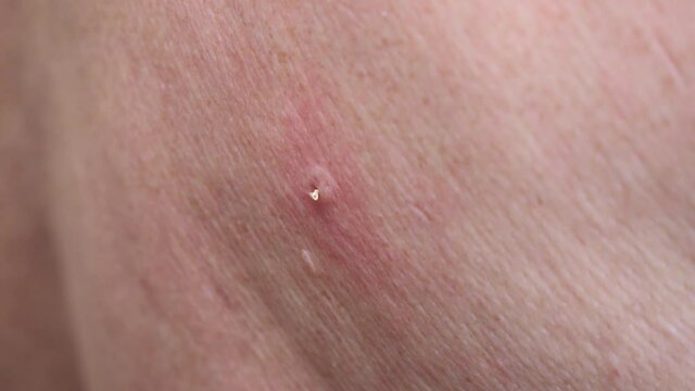 Bee sting for healing and human health. Medicinal properties of bee venom.