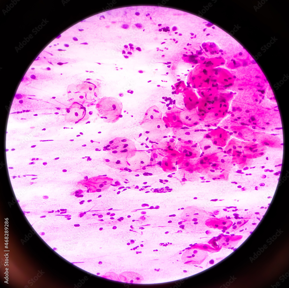 Poster Cervical smear (paps) cytology at histopathology laboratory. Microscopic 40x objective view of reactive cellular changes associated with severe inflammation, selective focus