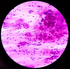 Cervical smear (paps) cytology at histopathology laboratory. Microscopic 40x objective view of...