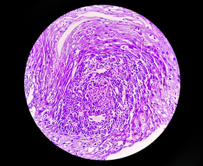 Adenocarcinoma of esophagus. Esophageal cancer or cancer of the food pipe.